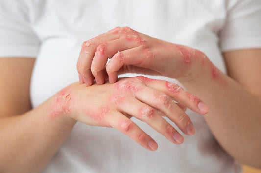 What Your GP Isn't Telling You About Psoriasis